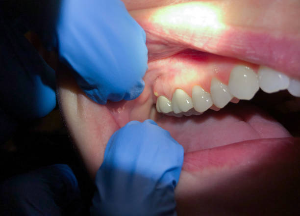 Best Emergency Wisdom Tooth Extraction in Salem, IN